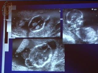 Encéphalocèle et brides