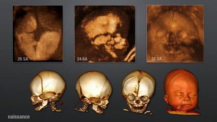 L'imagerie des pathologies squelettiques et cérébrales avec les sondes haute fréquence 2D ou 3D électroniques
