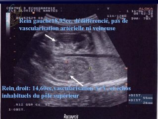 Thrombose rénale