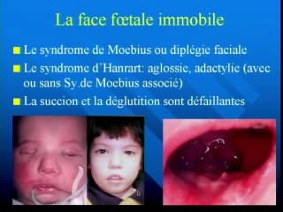 La mobilité faciale : qu’est-ce qu’une face immobile, dans quels cas rechercher ce signe ? Pourquoi et quand observer la succion et la déglutition,? La mobilité, porte du dépistage des pathologies neurologiques, du Robin au Moebius.