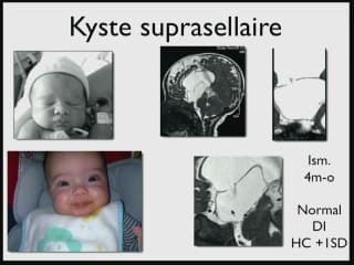 kystes interhémispheriques : toujours une bonne nouvelle