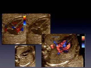 RVPAT : enseignement d’un diagnostic non fait