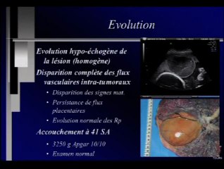 Anasarque par shunt artério foetal. A circonstances exceptionnelles, traitements exceptionnels ?