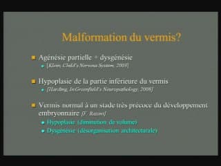 Dandy Walker et diagnostic prénatal : apport de l'imagerie et de la génétique.