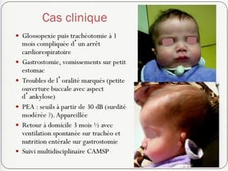 Teratogénicité du mycophénolate :1 cas de syndrôme de Franceschetti-like