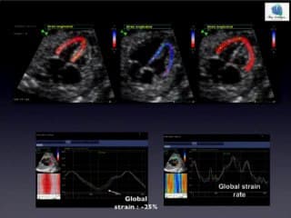 Analyse du « strain » myocardique dans une population de retard de croissance intra utérin à haut risque de décompensation cardiaque