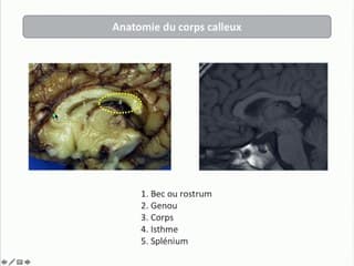 Cerveau foetal I : c’est trop petit ! Les petits corps calleux
