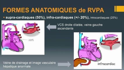 RVPT retour veineux pulmonaire total