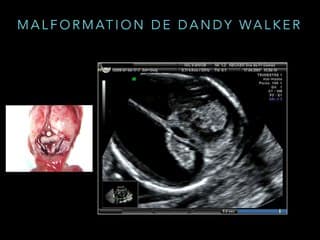 Le 1er trimestre  Diagnostics très précoces