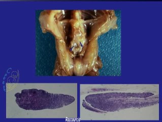Aspect foeto-pathologique des chondrodysplasies