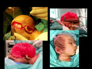 Tumeurs cervico-faciales – Urgences néonatales