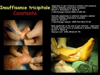 PRiSE EN CHaRGE DES PiEDS bOtS Les défauts résiduels