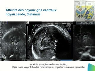 Images cérébrales foetales dues au CMV : quelle signification ?