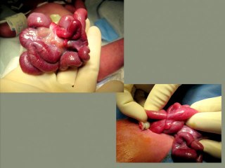Diagnostic et prise en charge des laparoschisis compliqués