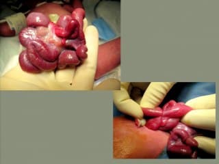 Diagnostic et prise en charge des laparoschisis compliqués