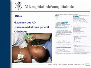 Microphtalmie/anophtalmie :prise en charge anténale et post-natale