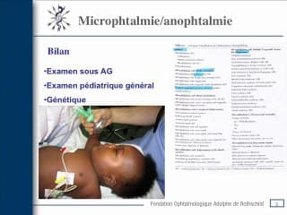 Microphtalmie/anophtalmie :prise en charge anténale et post-natale