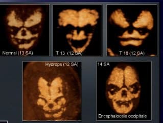 Les anomalies du squelette foetal