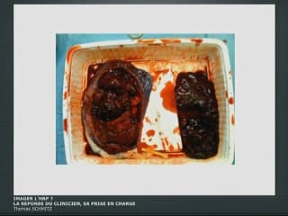 Imager l’HRP ? La réponse du clinicien, sa prise en charge