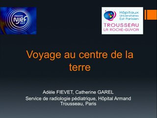 Anomalies ligne médiane : post-hypophyse ectopique