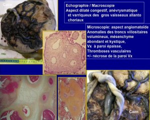 Les gros placentas dysplasie mesenchymateuse placentaire