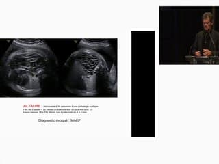 pleuro pneumo blastome