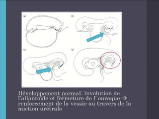 Le syndrome de PRUNE BELLY : avons-nous tout compris ?