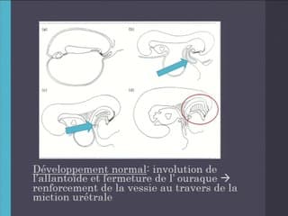 Le syndrome de PRUNE BELLY : avons-nous tout compris ?
