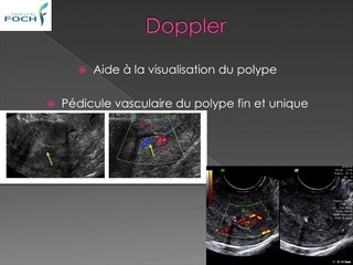 Bilan de l’utérus* polype, cicatrice de césarienne