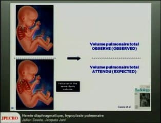 Hernie diaphragmatique, hypoplasie pulmonaire