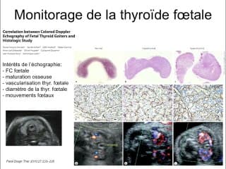 Que doit-on chercher chez le foetus lorsque la patiente est malade ? Pathologies thyroïdiennes et grossesse